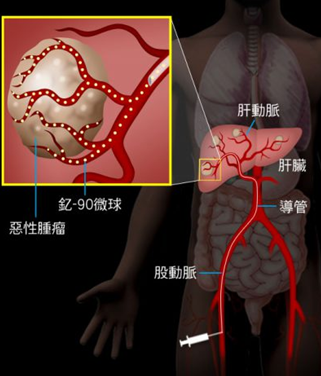 香港新型抗癌技术，钇90放射治疗大肠癌肝转移疗效显著
